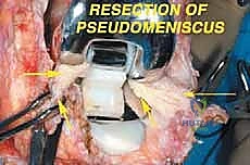 صورة توضيحية لـ إعادة بناء عظم الفخذ البعيد بالطرف الاصطناعي: أمل جديد لمرضى أورام العظام في صنعاء مع الأستاذ الدكتور محمد هطيف