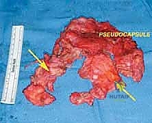 صورة طبية: إعادة بناء عظم الفخذ البعيد بالطرف الاصطناعي: أمل جديد لمرضى أورام العظام في صنعاء مع الأستاذ الدكتور محمد هطيف