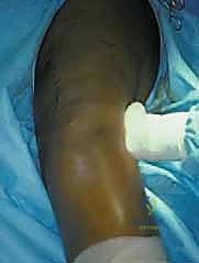 صورة طبية: إعادة بناء عظم الفخذ البعيد بالطرف الاصطناعي: أمل جديد لمرضى أورام العظام في صنعاء مع الأستاذ الدكتور محمد هطيف