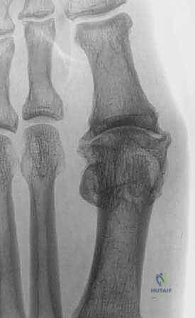 تحضير المفصل وإزالة الزوائد العظمية