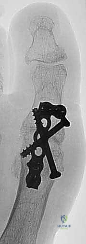 Illustration of mtp joint arthrodesis - Dr. Mohammed Hutaif