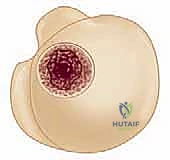 FIG 4  Radiographic findings in osteoarthritis include osteophyte formation especially on the inferior humerus as seen on the AP view  A  and asymmetrical posterior glenoid wear with posterior subluxation as seen on the axillary view  B