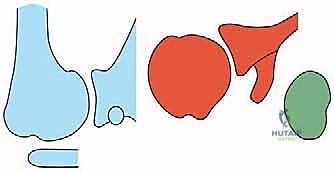 Hemiarthroplasty, Total Shoulder Arthroplasty, and Biologic Glenoid Resurfacing for Glenohumeral Arthritis With an Intact Rotator Cuff