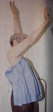 FIG 4  Radiographic findings in osteoarthritis include osteophyte formation especially on the inferior humerus as seen on the AP view  A  and asymmetrical posterior glenoid wear with posterior subluxation as seen on the axillary view  B