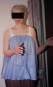 FIG 4  Radiographic findings in osteoarthritis include osteophyte formation especially on the inferior humerus as seen on the AP view  A  and asymmetrical posterior glenoid wear with posterior subluxation as seen on the axillary view  B