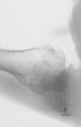 FIG 4  Radiographic findings in osteoarthritis include osteophyte formation especially on the inferior humerus as seen on the AP view  A  and asymmetrical posterior glenoid wear with posterior subluxation as seen on the axillary view  B