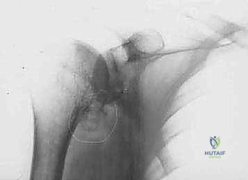 FIG 4  Radiographic findings in osteoarthritis include osteophyte formation especially on the inferior humerus as seen on the AP view  A  and asymmetrical posterior glenoid wear with posterior subluxation as seen on the axillary view  B
