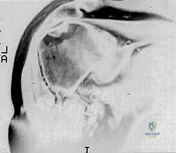 FIG 4  Radiographic findings in osteoarthritis include osteophyte formation especially on the inferior humerus as seen on the AP view  A  and asymmetrical posterior glenoid wear with posterior subluxation as seen on the axillary view  B