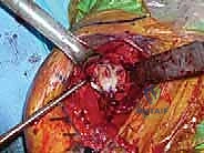 TECH FIG 8  A center pilot hole is drilled in the glenoid surface  A  and a spherical reamer is used to create a concentric surface  B