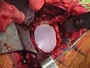 TECH FIG 8  A center pilot hole is drilled in the glenoid surface  A  and a spherical reamer is used to create a concentric surface  B