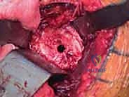 TECH FIG 8  A center pilot hole is drilled in the glenoid surface  A  and a spherical reamer is used to create a concentric surface  B