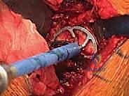 TECH FIG 8  A center pilot hole is drilled in the glenoid surface  A  and a spherical reamer is used to create a concentric surface  B