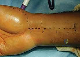 خيارات العلاج التحفظي والجبائر