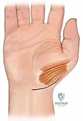 صورة توضيحية لـ علاج عدم استقرار مفصل إبهام اليد: تثبيت الأربطة جراحياً مع الأستاذ الدكتور محمد هطيف