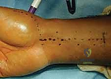 صورة توضيحية لـ علاج عدم استقرار مفصل إبهام اليد: تثبيت الأربطة جراحياً مع الأستاذ الدكتور محمد هطيف