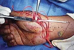 صورة توضيحية لـ علاج عدم استقرار مفصل إبهام اليد: تثبيت الأربطة جراحياً مع الأستاذ الدكتور محمد هطيف