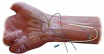 صورة توضيحية لـ علاج عدم استقرار مفصل إبهام اليد: تثبيت الأربطة جراحياً مع الأستاذ الدكتور محمد هطيف