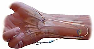 صورة توضيحية لـ علاج عدم استقرار مفصل إبهام اليد: تثبيت الأربطة جراحياً مع الأستاذ الدكتور محمد هطيف