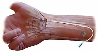 الحقن الموضعي في مفصل الإبهام