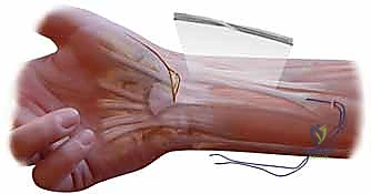 صورة طبية: علاج عدم استقرار مفصل إبهام اليد: تثبيت الأربطة جراحياً مع الأستاذ الدكتور محمد هطيف