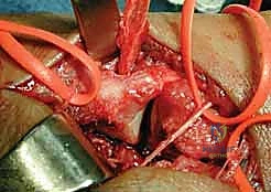 صورة توضيحية لـ علاج عدم استقرار مفصل إبهام اليد: تثبيت الأربطة جراحياً مع الأستاذ الدكتور محمد هطيف