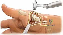 صورة توضيحية لـ علاج عدم استقرار مفصل إبهام اليد: تثبيت الأربطة جراحياً مع الأستاذ الدكتور محمد هطيف