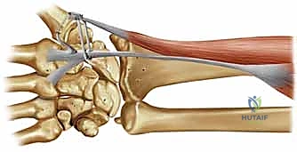 علاج عدم استقرار مفصل إبهام اليد: تثبيت الأربطة جراحياً مع الأستاذ الدكتور محمد هطيف