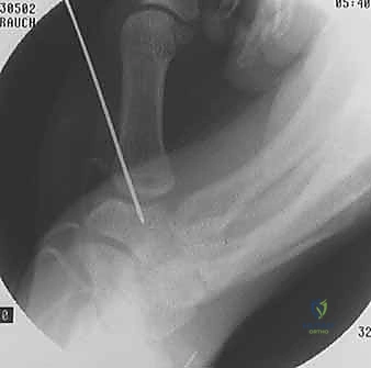 Illustration of flexor carpi radialis tendon - Dr. Mohammed Hutaif