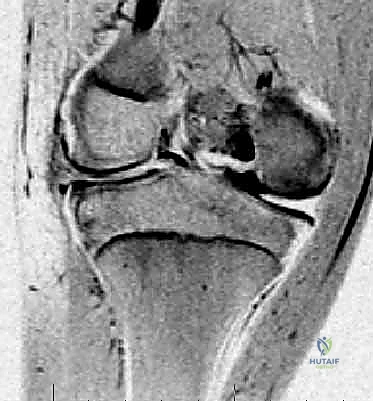 تصنيف أنواع الغضروف الهلالي القرصي الجانبي