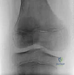 جراحة الغضروف الهلالي القرصي الجانبي بالمنظار: دليلك الشامل للتشخيص والعلاج والتعافي مع الأستاذ الدكتور محمد هطيف