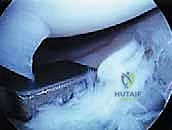 خطوات جراحة الغضروف الهلالي القرصي بالمنظار