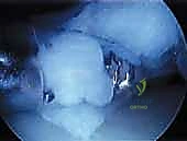 التعافي والعلاج الطبيعي بعد جراحة الغضروف الهلالي