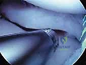 Illustration of discoid lateral meniscus - Dr. Mohammed Hutaif