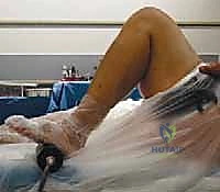 Mastering Revision Total Knee Arthroplasty: Meticulous Removal of Well-Fixed Components