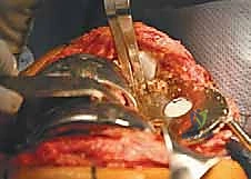 الأسباب والدواعي الطبية لمراجعة مفصل الركبة الكلي