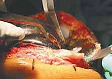 التشريح المعقد لمفصل الركبة وأهميته في جراحة المراجعة