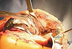 جراحة مراجعة مفصل الركبة الكلي: حلول متقدمة للمكونات الثابتة بإشراف الأستاذ الدكتور محمد هطيف في صنعاء