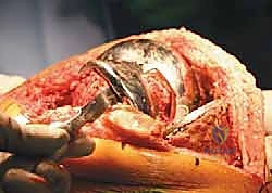 التخطيط الجراحي الدقيق قبل عملية المراجعة