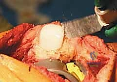 صورة توضيحية لـ جراحة مراجعة مفصل الركبة الكلي: حلول متقدمة للمكونات الثابتة بإشراف الأستاذ الدكتور محمد هطيف في صنعاء