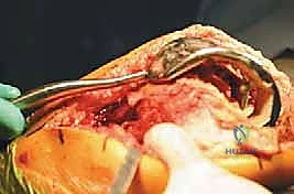 التقنيات الحديثة في جراحة العظام مع الدكتور محمد هطيف