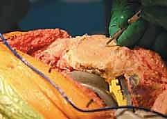 الأستاذ الدكتور محمد هطيف أفضل جراح عظام في صنعاء