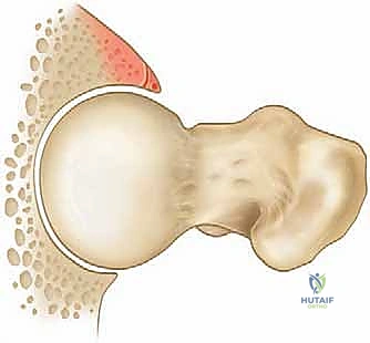 توضيح التشوه الهيكلي في انحشار الفخذ الحقي