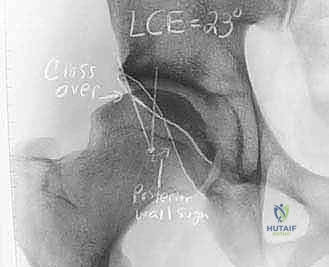 تأثير الرياضة والنشاط الحركي على مفصل الورك