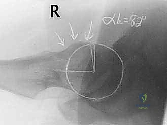 أعراض انحشار الفخذ الحقي ومناطق الألم