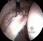 انحشار الكامة في مفصل الورك