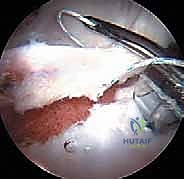 مقارنة شكل العظم قبل وبعد النحت