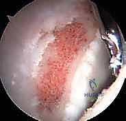 التخطيط الجراحي عبر الأشعة المقطعية