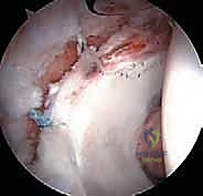 جلسات العلاج الطبيعي والتأهيل للورك