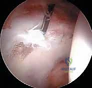 رؤية المفصل من الداخل عبر كاميرا المنظار