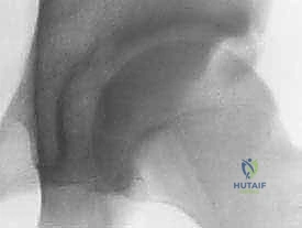 تشريح مفصل الورك ورأس عظم الفخذ